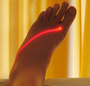 лазерно лечение на разширени вени по краката