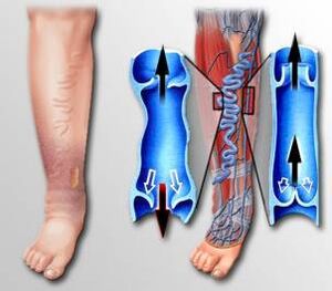 приток на кръв в крака с разширени вени