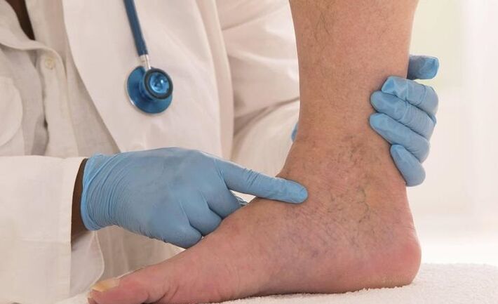 лекарят изследва крака с разширени вени