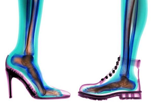 удобни и неудобни обувки за профилактика на разширени вени