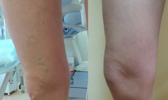 крак преди и след лечение на ретикуларни разширени вени