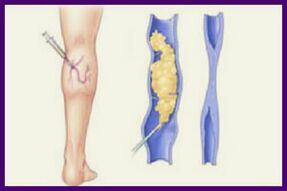 Склеротерапията е популярен метод за премахване на разширени вени на краката